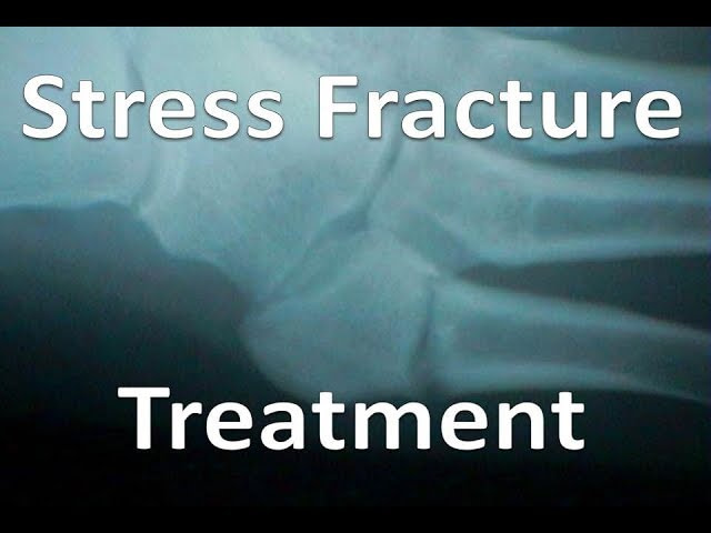 heel stress fracture treatment