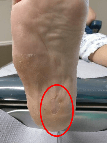 Getting Glass Out of My Foot: The Top 3 Secrets To Getting It Out.