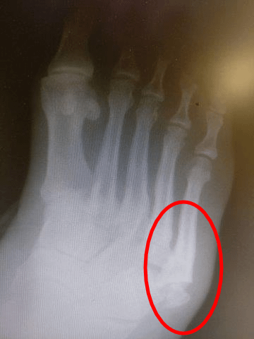 sprained sprain foot