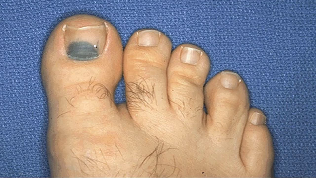 big toe nail changing color and falling off