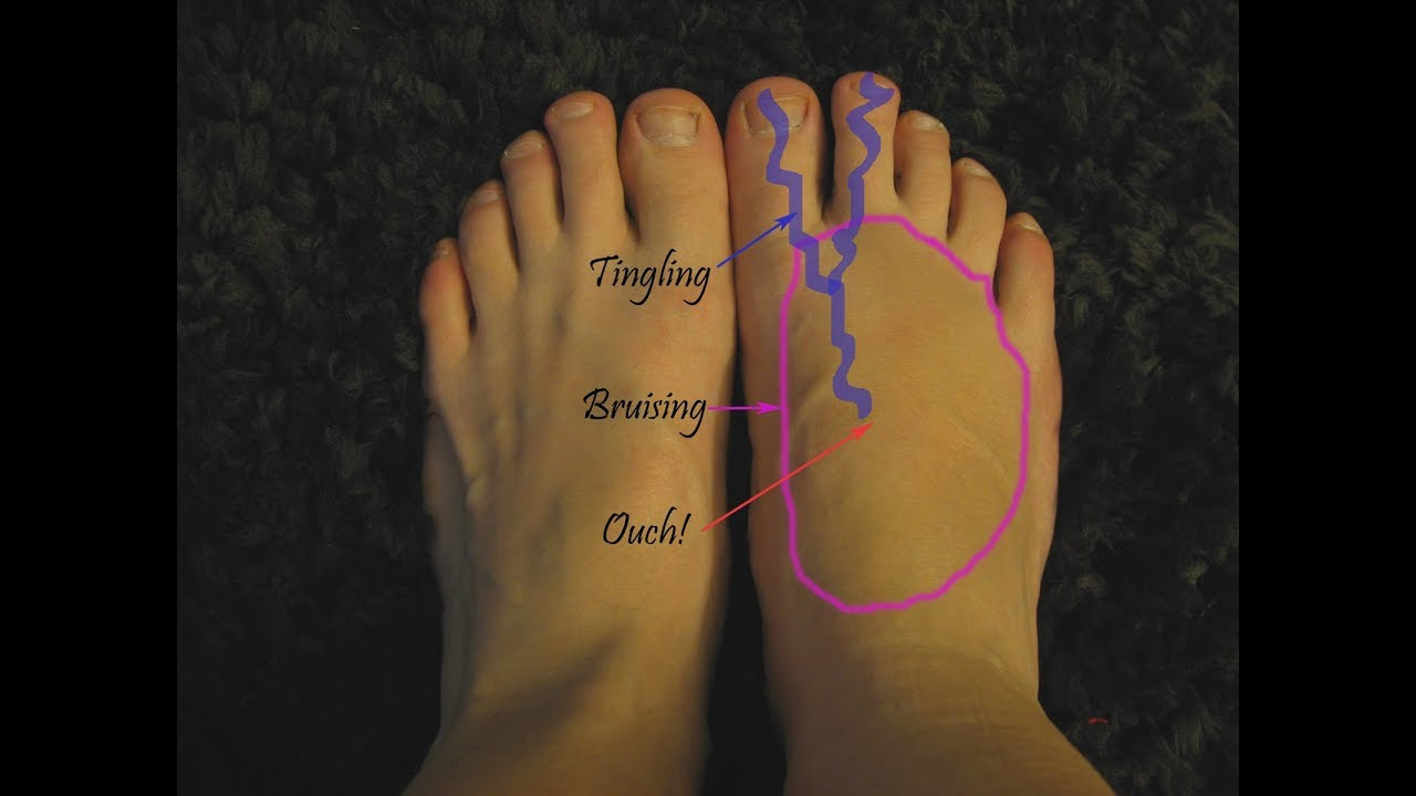 foot arch pain