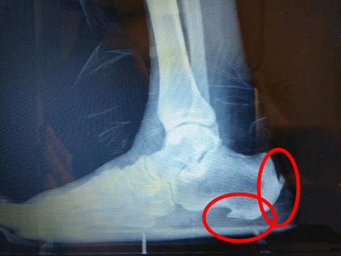 Heel Spur Surgery Recovery Time: [Is It 