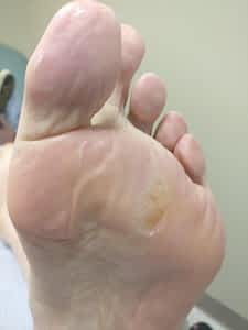 hard spot on the bottom of my foot