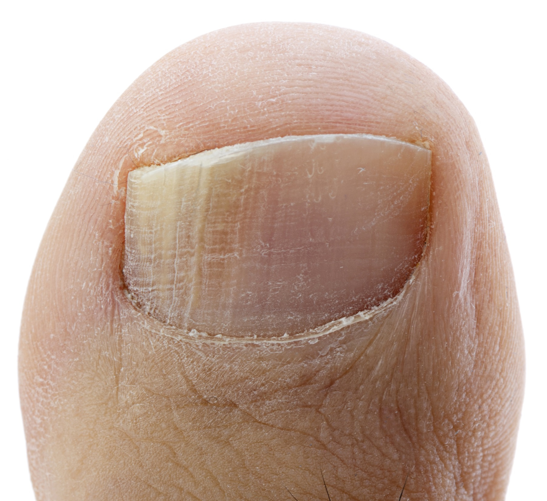 What To Do For Really Bad Toenail Fungus