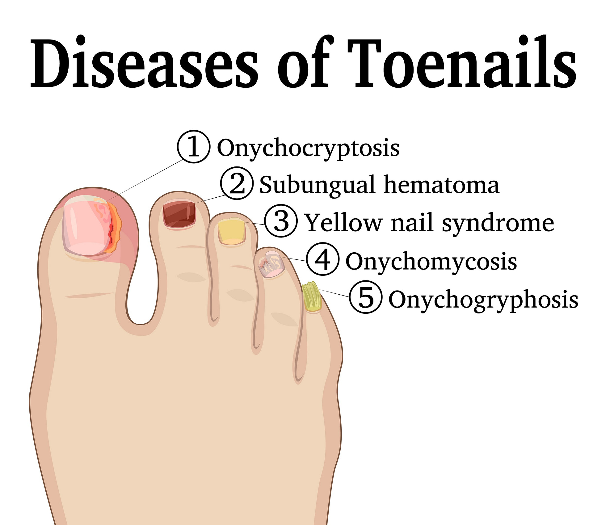 Nail Pitting Causes Symptoms Home Remedies Best Treatment   Toenail Disease Ingrown Toenail Hematoma Yellow Toenail Onygryphosis 