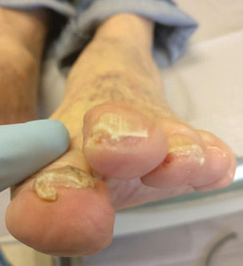 Toenail Fungus With A Nail Falling Off? This is the SECRET ...