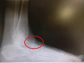 running with bone spur on top of foot
