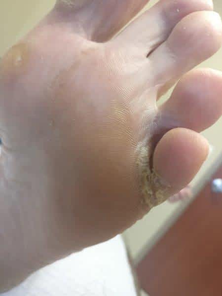 Sharp And Shooting Pain In The Little Toe Causes Best Treatment