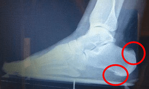 heel bone spur surgery recovery