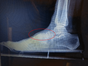 bone spur on top of foot images