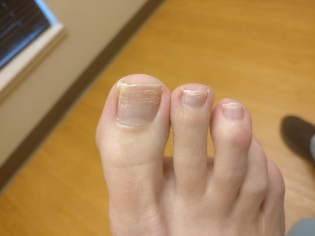 White Chalky Toenails From Nail Polish Causes Home Remedies   Img 20191126 143551 