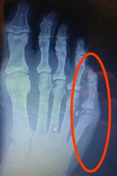toe sprained pinky fracture metatarsal treatment michiganfootdoctors bone sprain