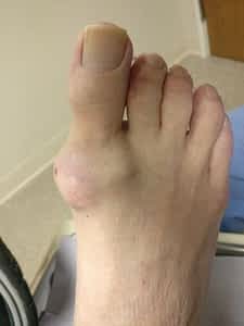 Gout On Top of Foot [Causes, Symptoms 