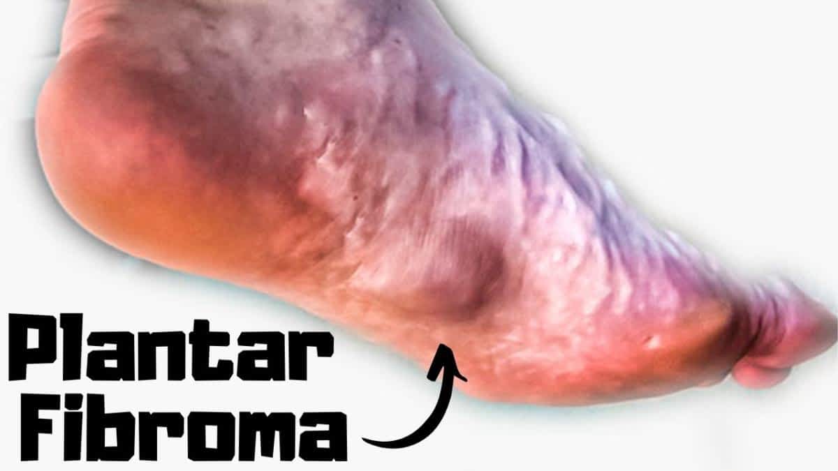 best insoles for plantar fibroma