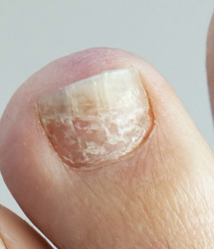 white-spots-on-nails-trauma