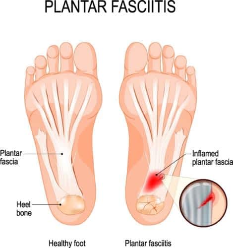 Overpronation Flat Foot Pain? [Top 3 PROVEN Flat Feet Cures 2020!]