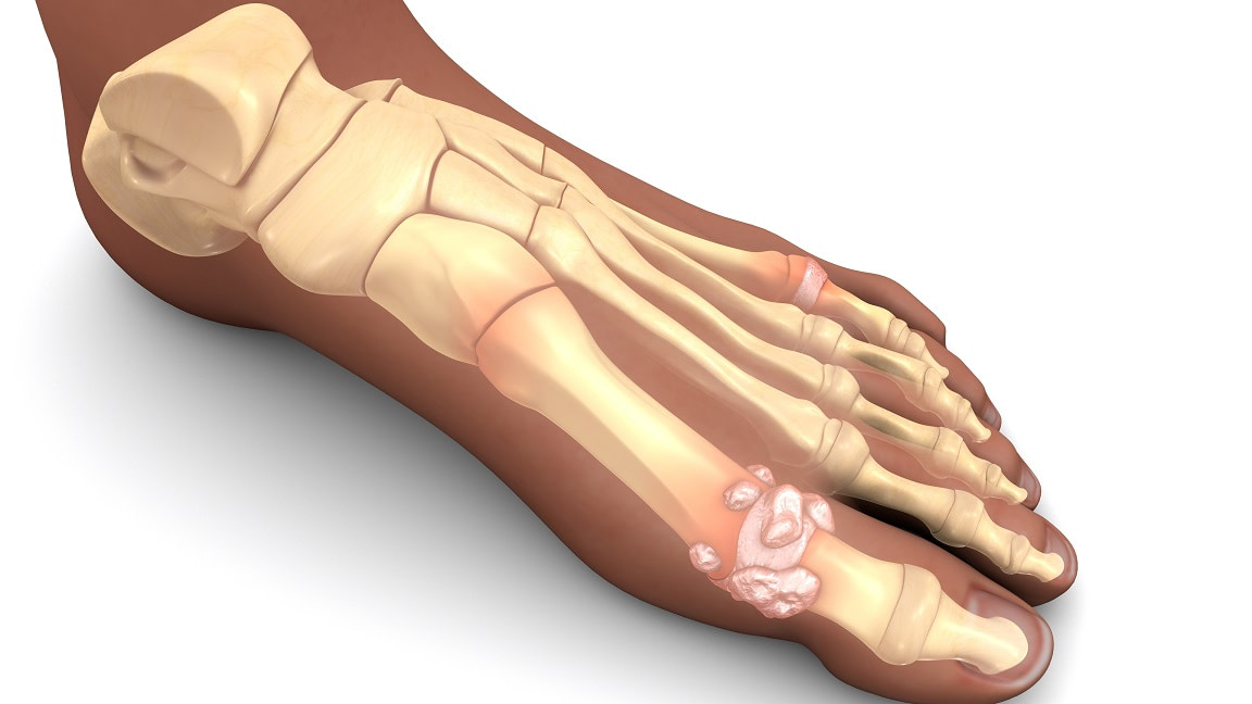 Ganglion Cyst In The Big Toe Joint Causes Symptoms And Best Treatment