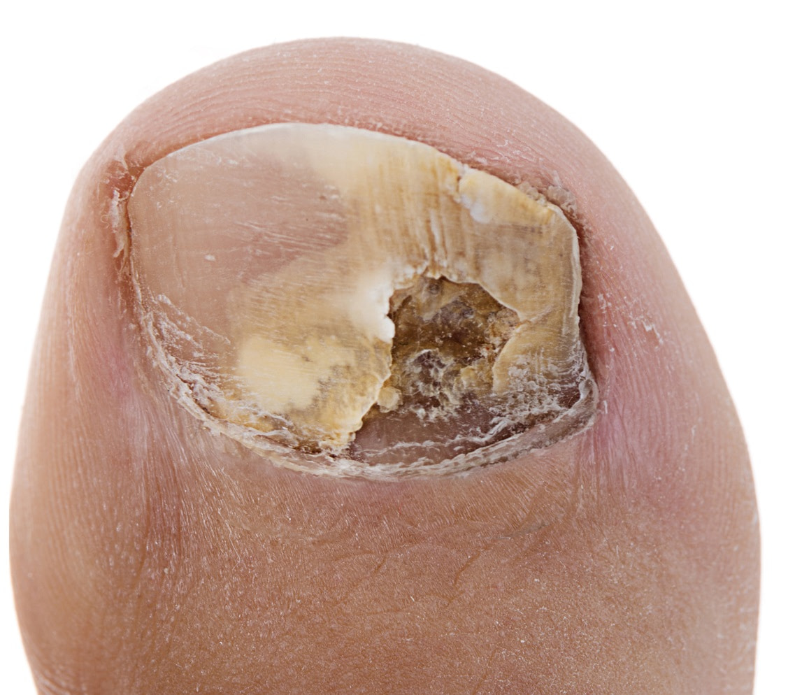 Thick Yellow Toenails [Causes, Home Remedies & Best Treatments!]