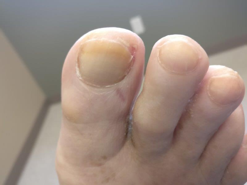 white-chalky-toenails-from-nail-polish-causes-home-remedies