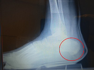 Broken Heel Bone Fracture [Causes 