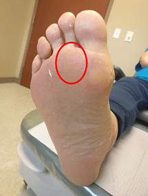 Capsulitis of the Second Toe Taping 