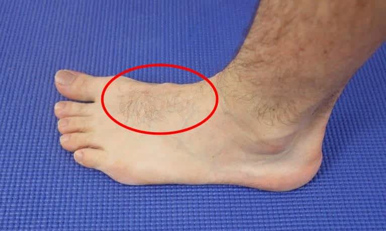 Foot Pain in the Top of the Arch 