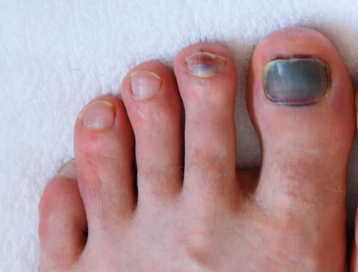 Foot Toe And Toenail Cancer Causes Symptoms And Best Treatment