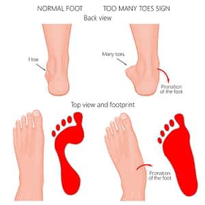 Mid Foot Pain [Causes, Symptoms & Best Home Treatment]