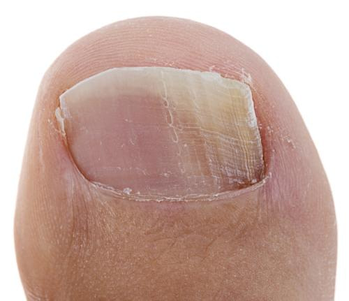 All 99+ Images white spots on toenails photos Stunning