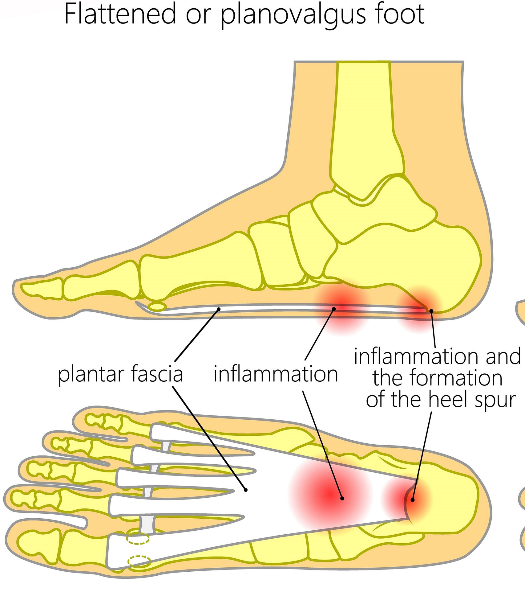 flat foot pain