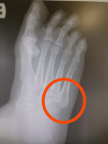 outside 5th protruding pinky metatarsal styloid sprained lump tendonitis mlpnbxpvg0op cuboid fracture peroneus brevis michiganfootdoctors bwg experienced