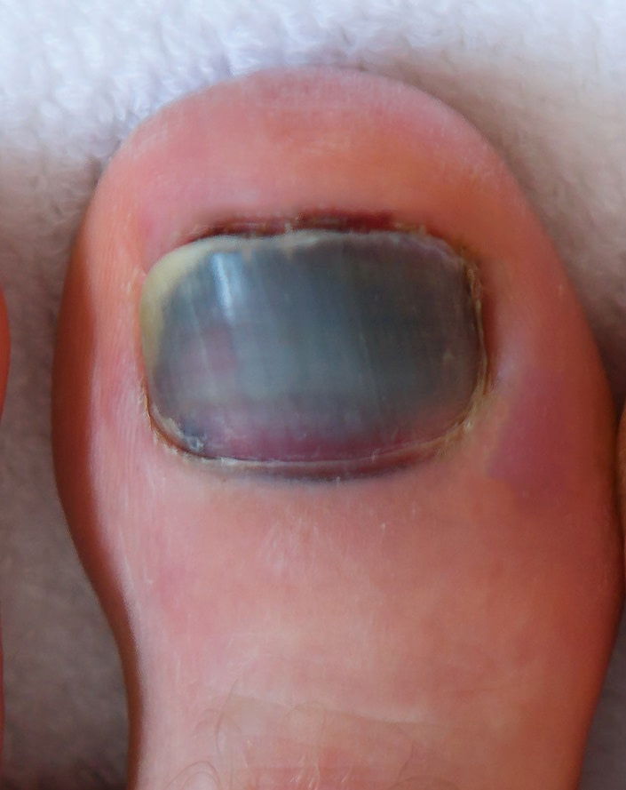 red-spot-under-toenail-causes-home-remedies-best-treatment