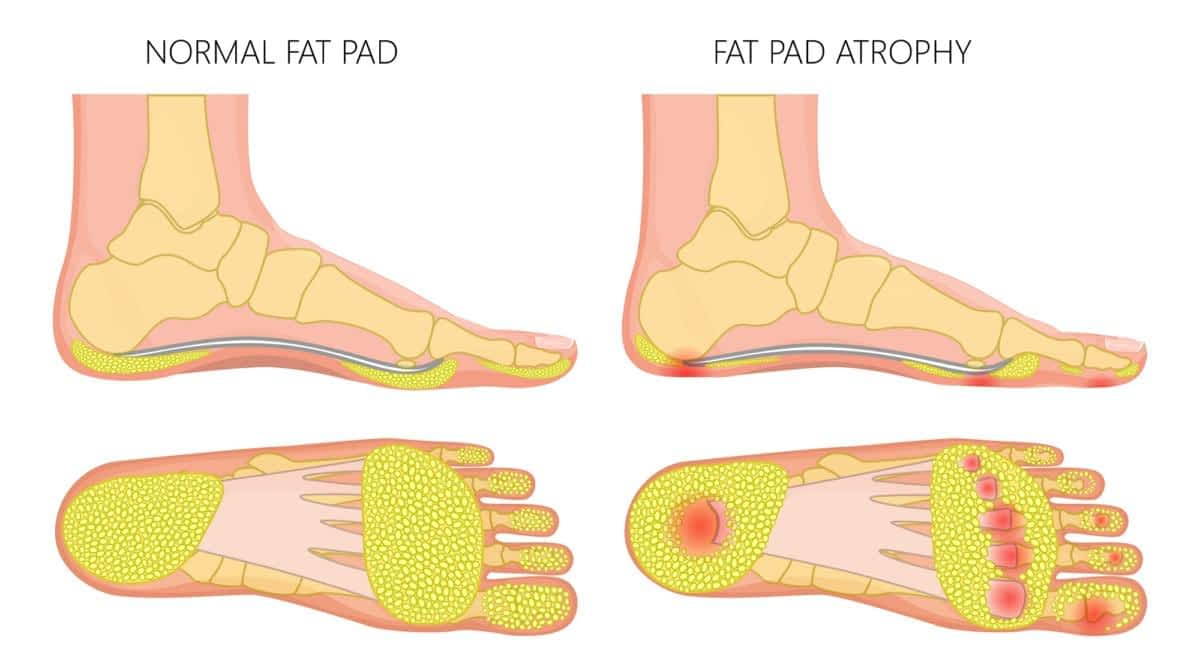 inflamed fat pad heel
