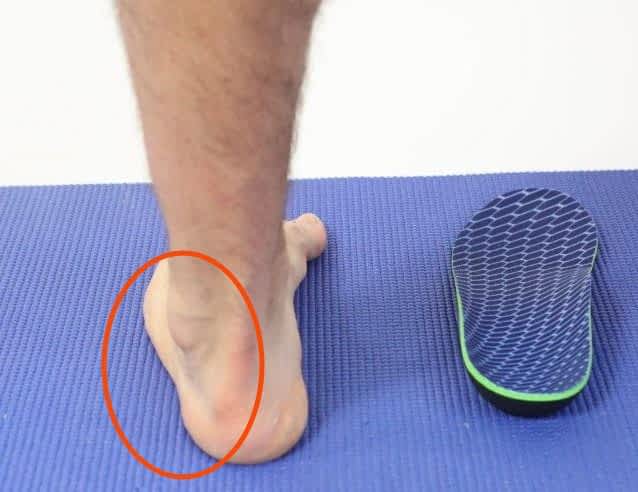 Pain on Outside of Foot Near Little Toe [Causes & Best Treatment]
