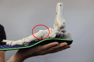 extra bone on top of foot