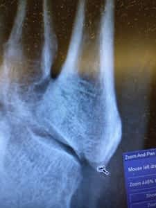 Chipped Shin Bone: Make 100% sure it's not broken!