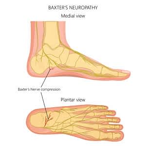 Tender Spot Bottom of Foot [Causes, Symptoms & Best Treatment]