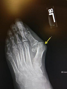 Big Toe Knuckle Pain [Causes, Symptoms & Best Treatment]