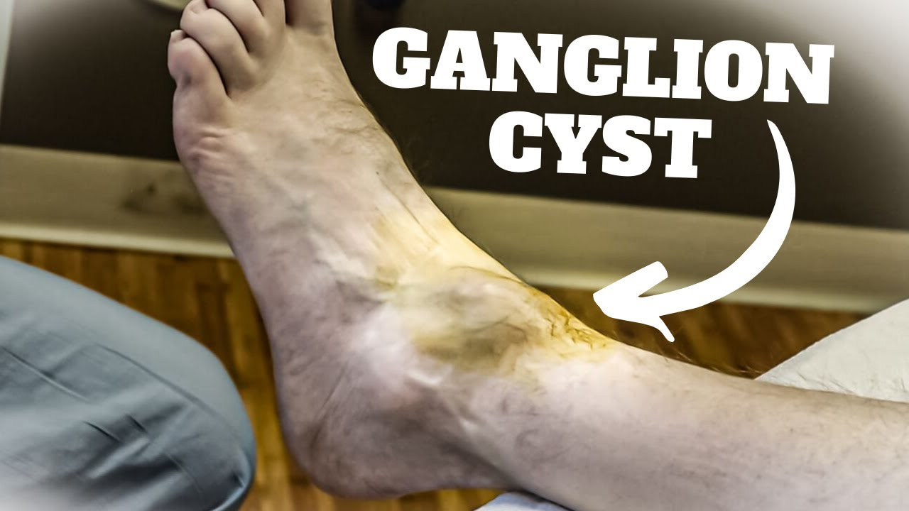 ganglion-cyst-foot-surgery-recovery-time-the-complete-guide