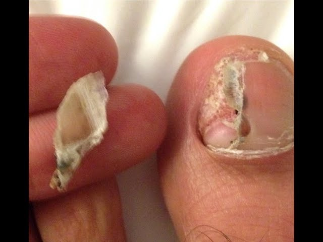 old-toenail-finally-fell-off-after-an-accident-a-month-or-so-ago-when